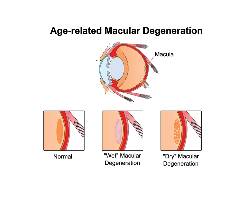 Illustration of Age-related Macular Degeneration