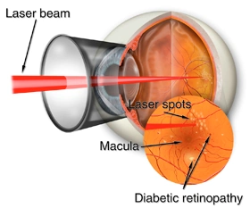 Diabetic Retinopathy diagram