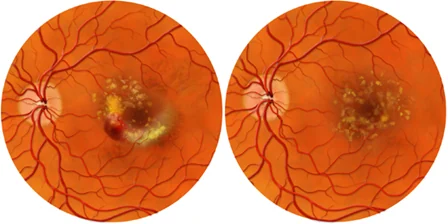 Age-related Macular Degeneration diagram