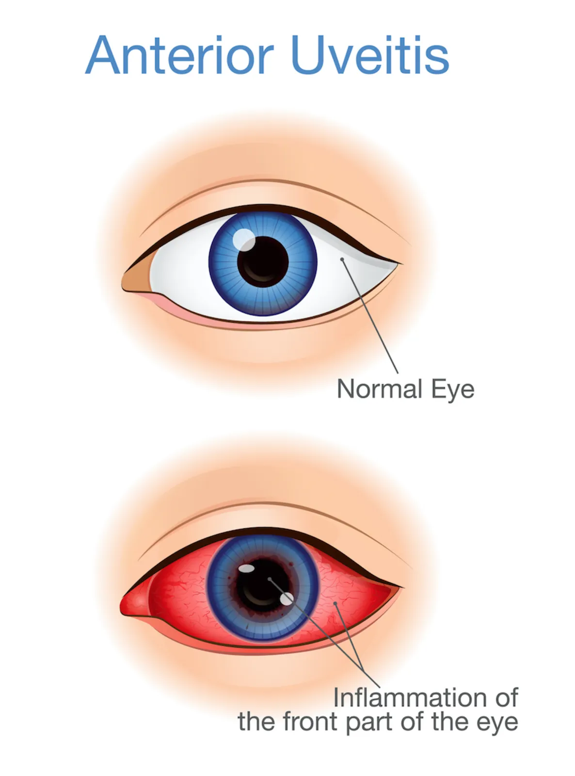 Human eye with Uveitis graphic