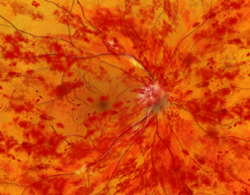 Image of Central Retinal Vein Occlusion