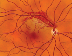 Image of Branch Retinal Vein Occlusion