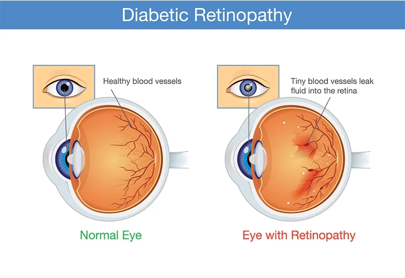 Illustration of Diabetic Retinopathy
