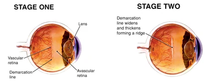 Retina stages graphic
