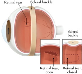 Retinal detachment diagram