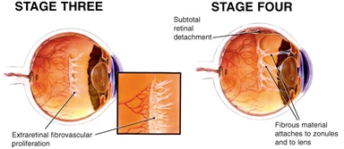 Retina stages three and for graphic