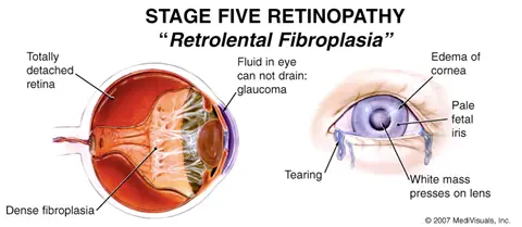 Stage five retinopathy graphic